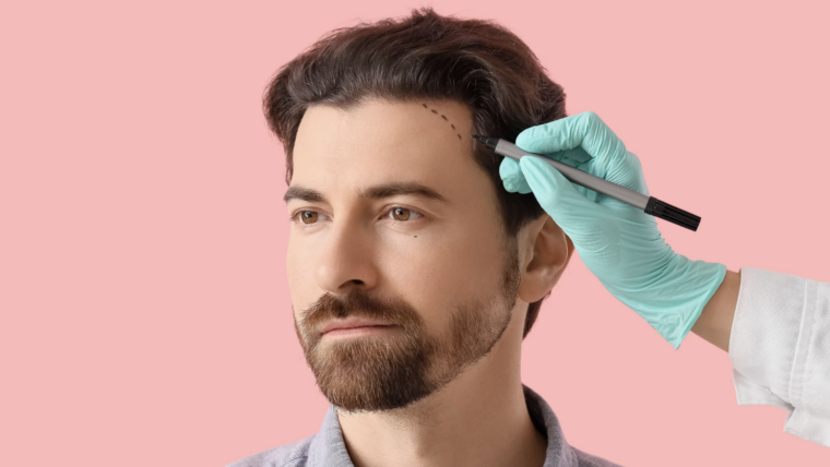 Hair Transplantation Best Results in Maryland